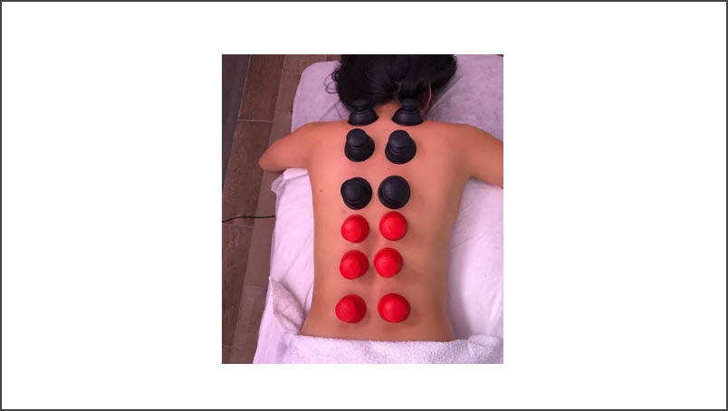 ​Cupping