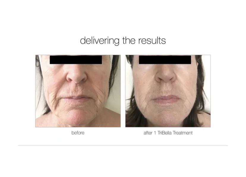 Tribella™ Facial