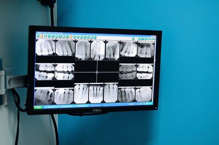 Dental X-Rays