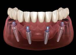 ALL IN 4 /6 IMPLANTS HYBRID DENTURES 