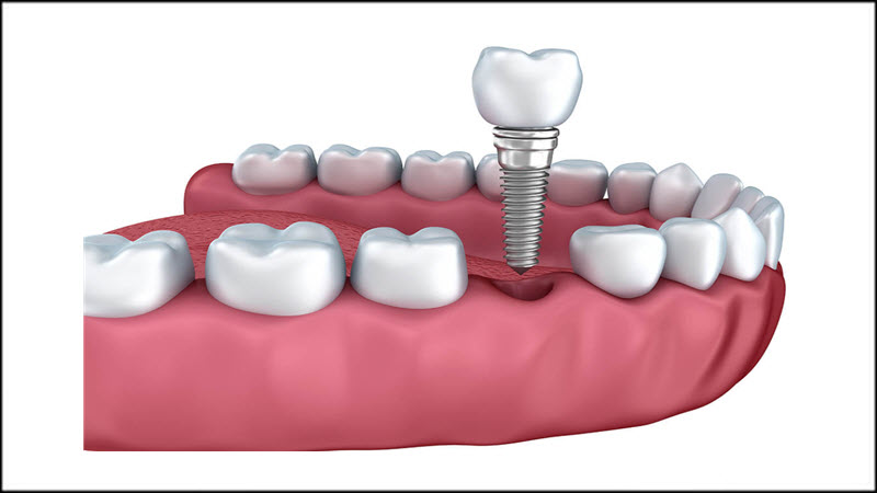  Dental Implants