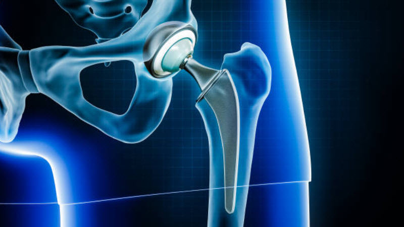 Hip Disarticulation