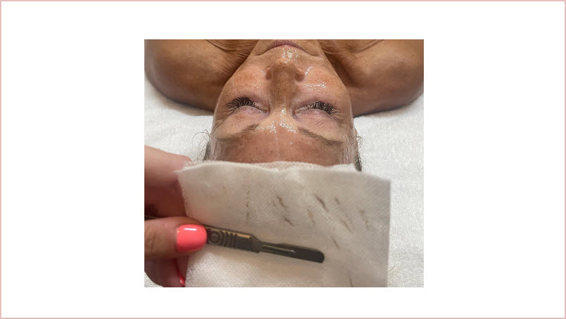 Dermaplaning