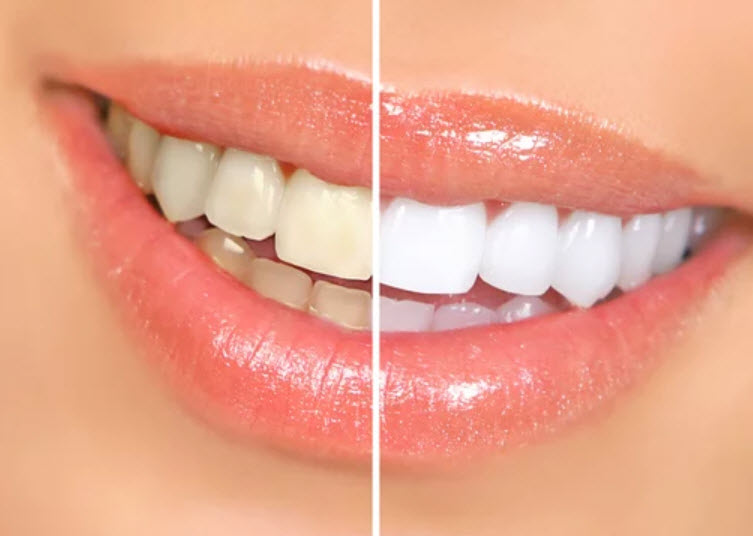 Teeth Whitening near Marietta, GA