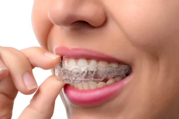 Clear Aligners near me in Augusta, GA