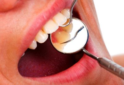 Oral Cancer Screening