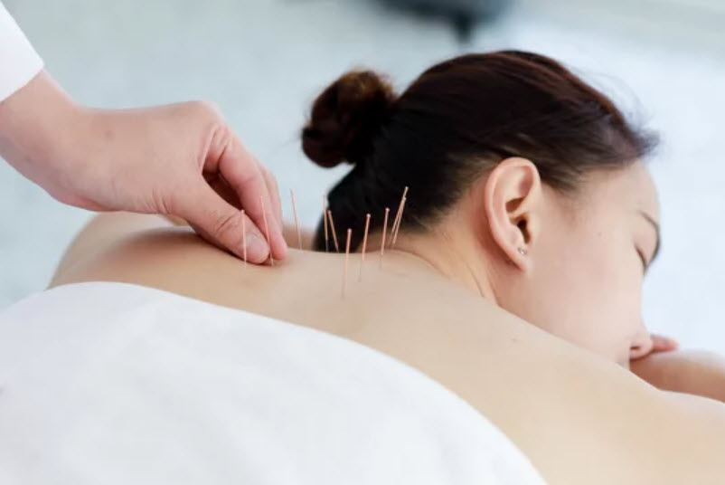 Acupuncture