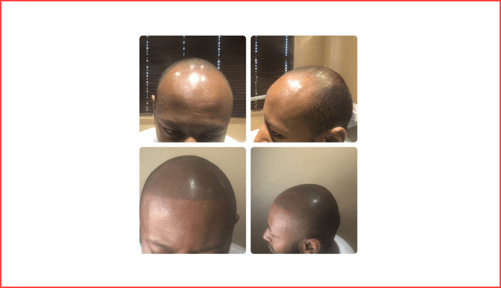 Scalp Micropigmentation
