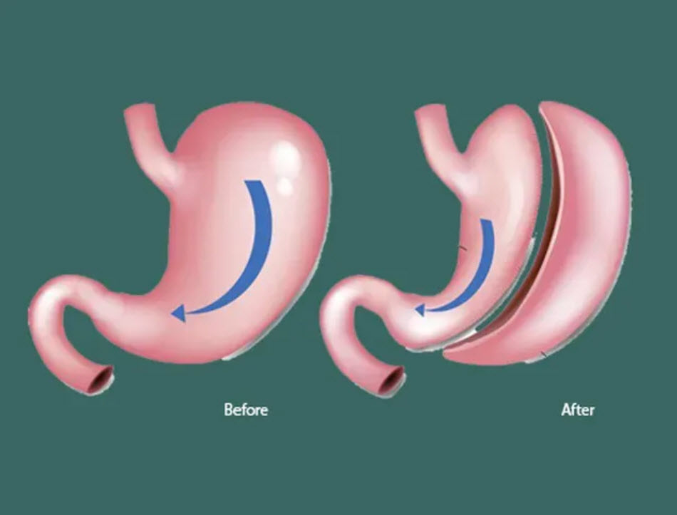 Gastric Sleeve