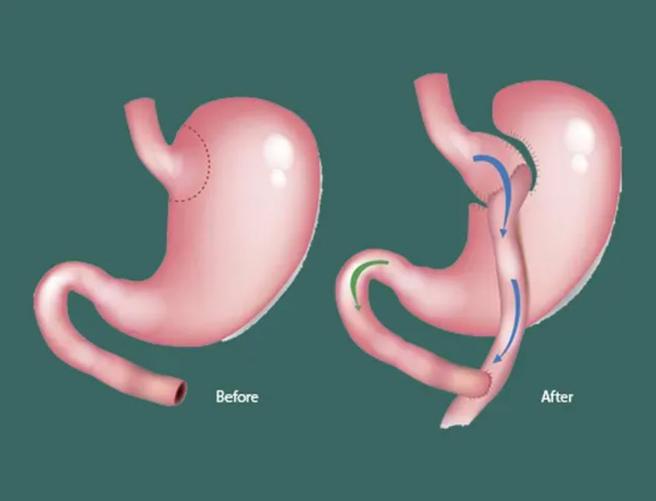 Gastric Bypass