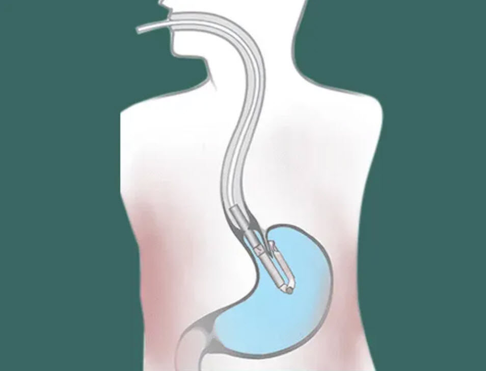 TIF Procedure