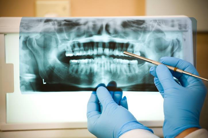 Root Canals