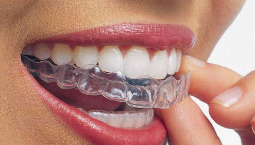 Invisalign®