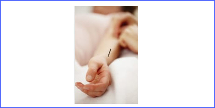 Follow-up Acupuncture