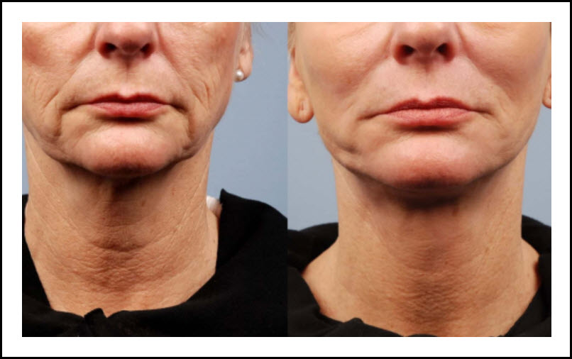 RF  Microneedling