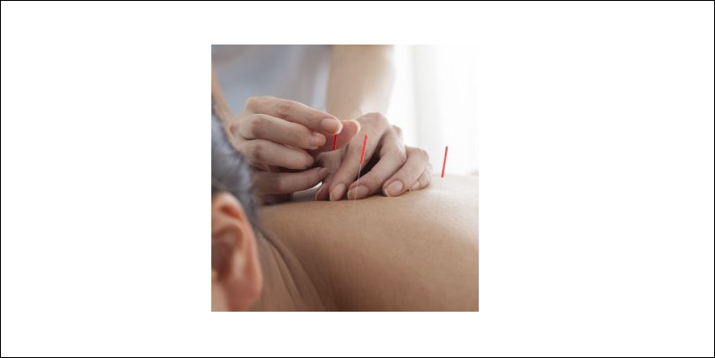 Acupuncture