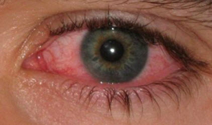 â€‹Ocular Surface Disease