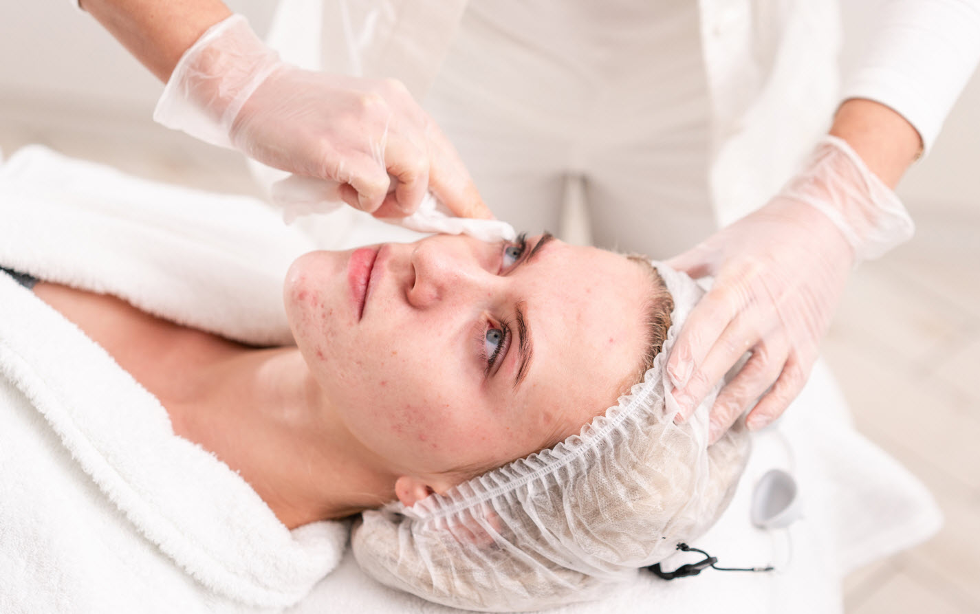 Acne Treatments