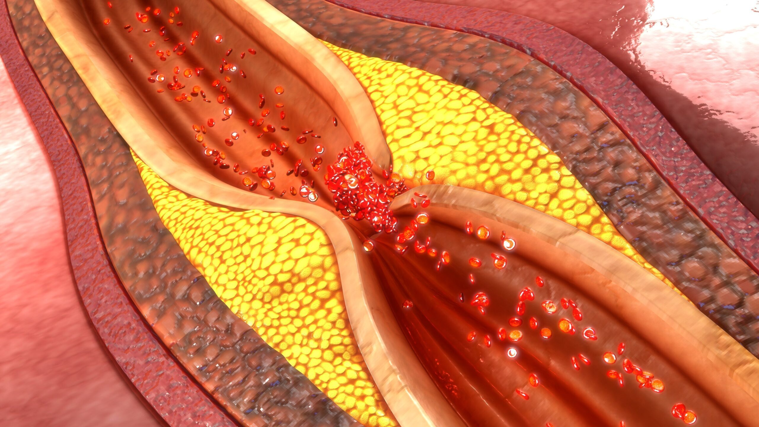 Coronary Artery Disease