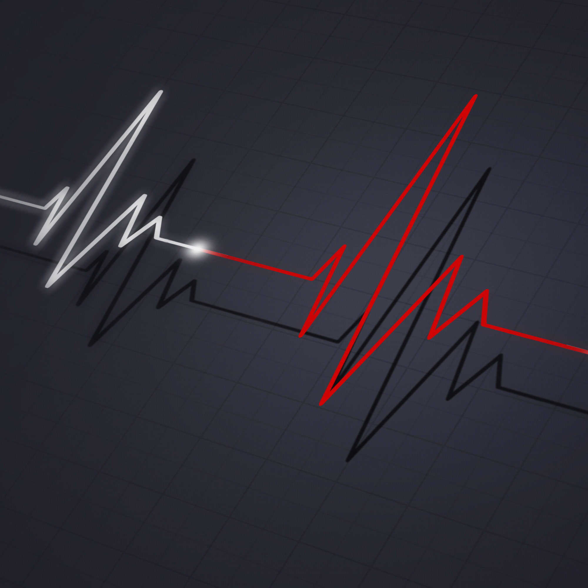 Abnormal Heart Rhythms/Arrythmias