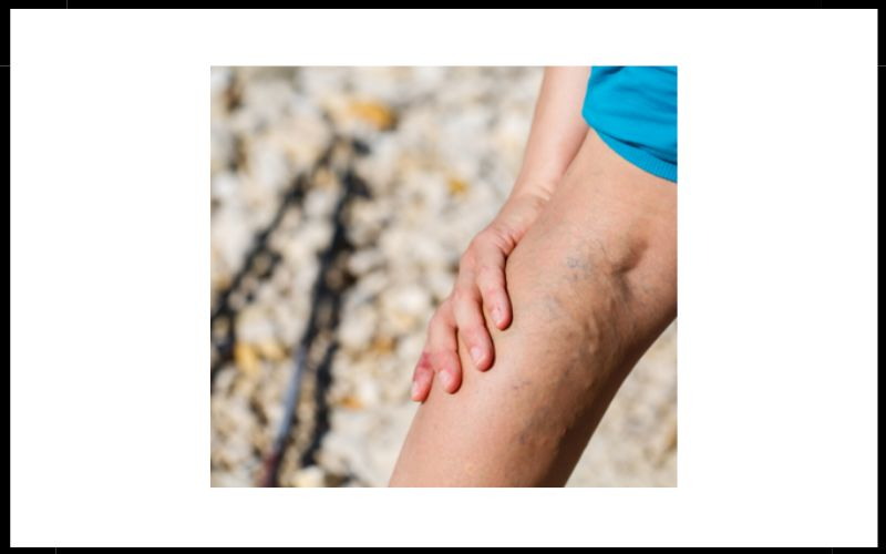 Varicose Veins
