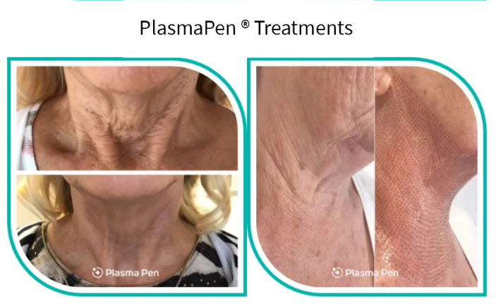 Plasma Fibroblasting