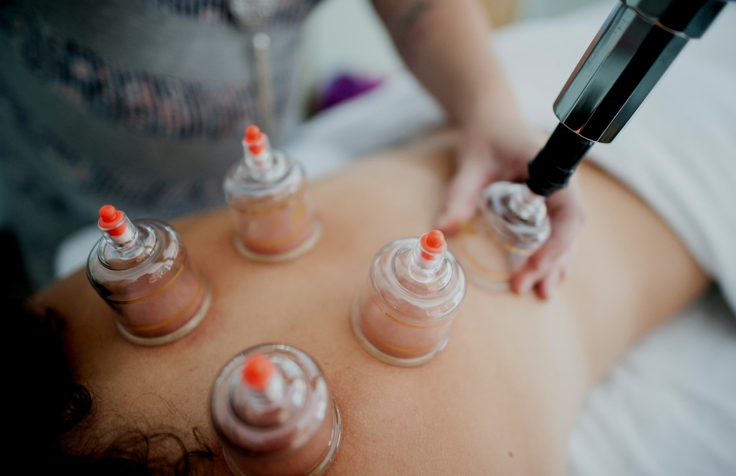 Cupping Therapy