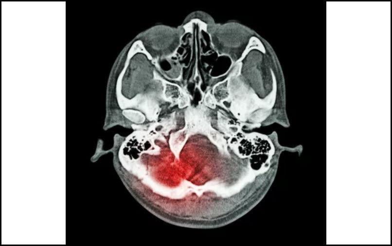 Skull Base Surgery