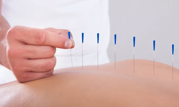 Acupuncture