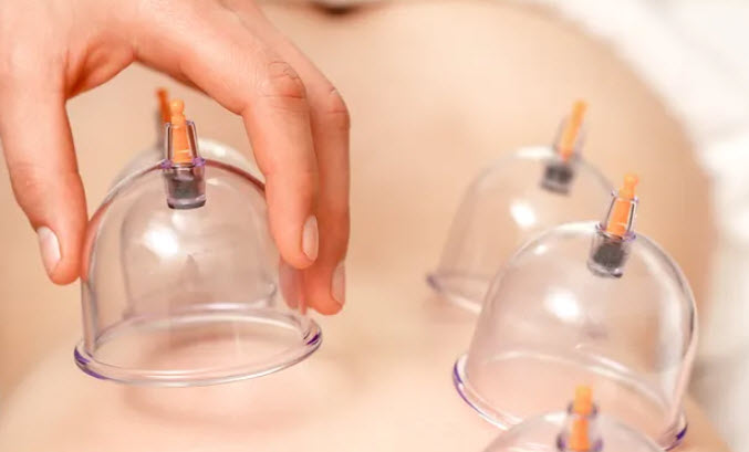 Cupping
