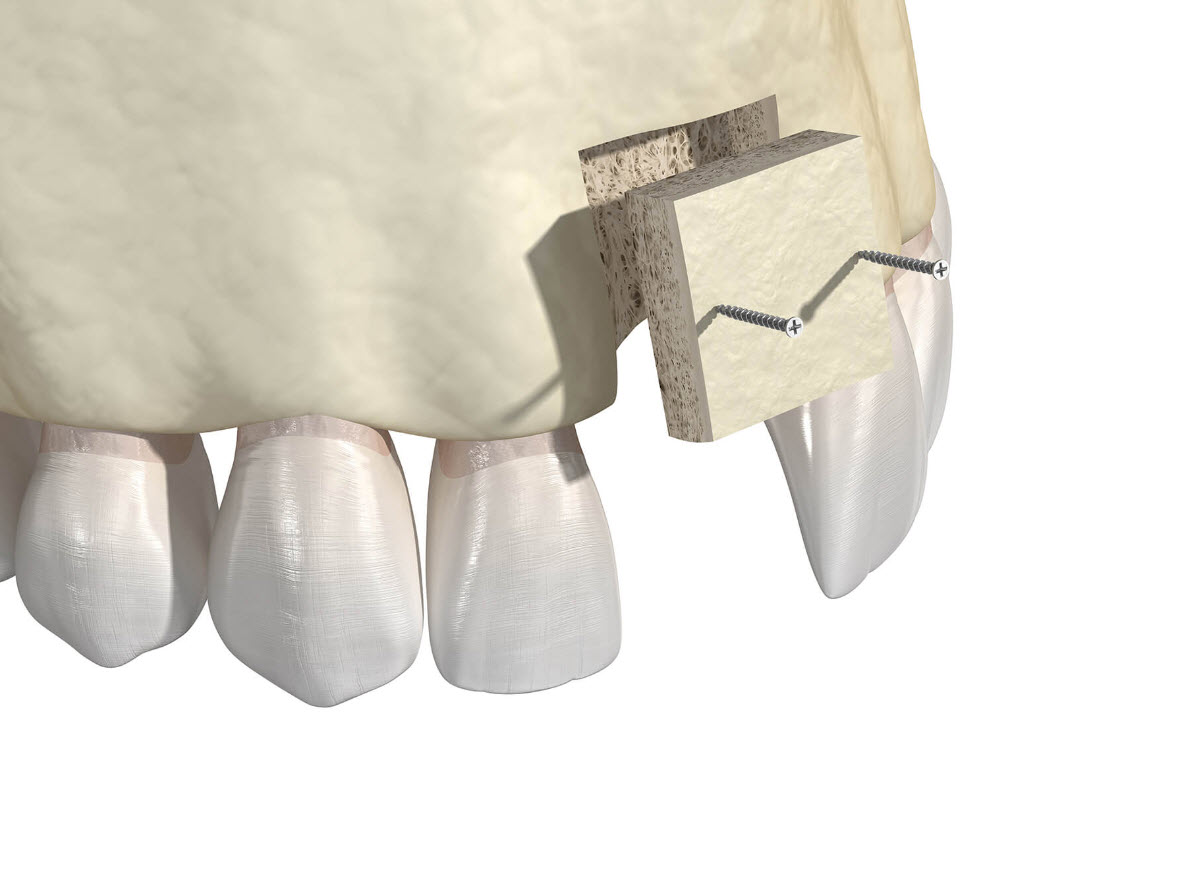 Bone Grafting