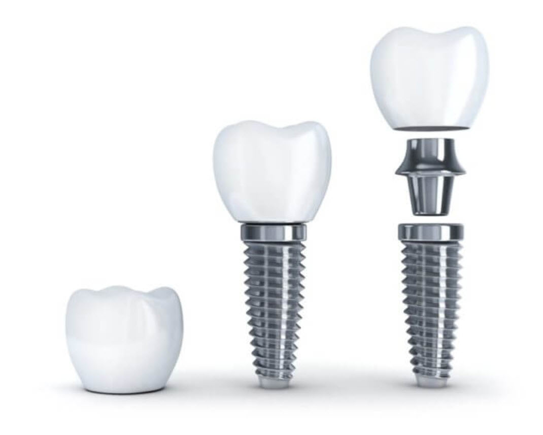 Dental Implants