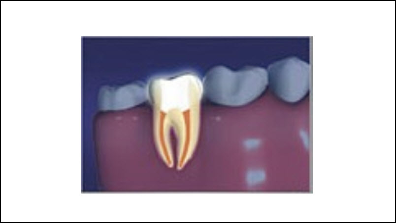  Root Canal