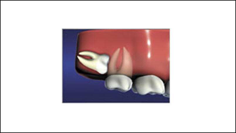  Wisdom Teeth
