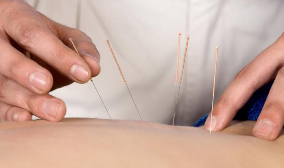 Acupuncture