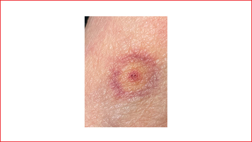 Tick Bite