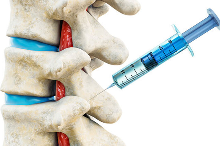 Facet Joint Injections